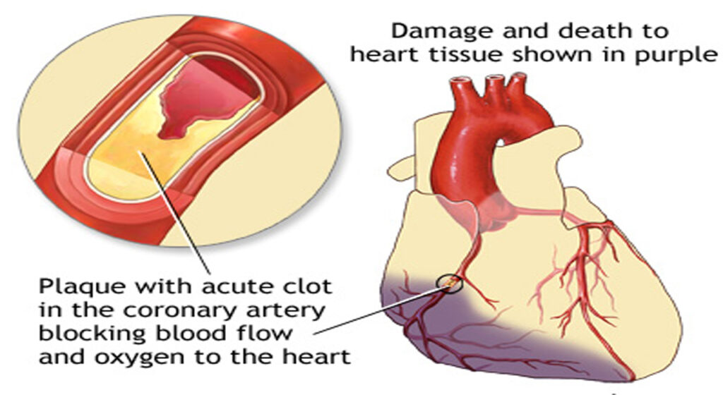 Tips for Heart Attack : Heart Block System