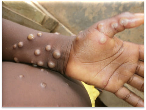 Mpox or Monkey Pox virus