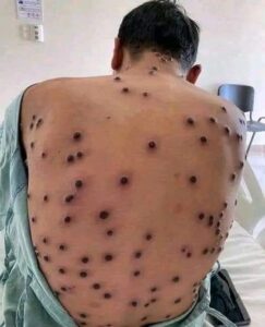 Mpox or Monkey Pox virus