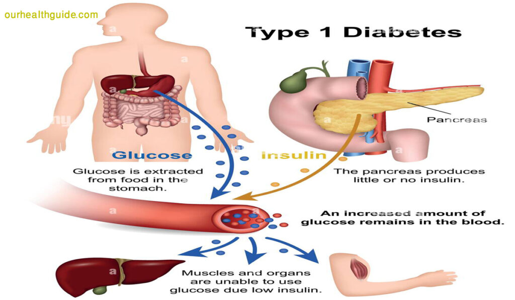 Type 1 Diabetes