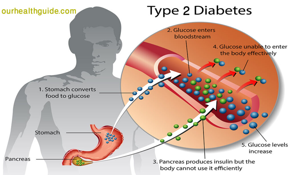 Effects of Type 2 Diabetes on the Body