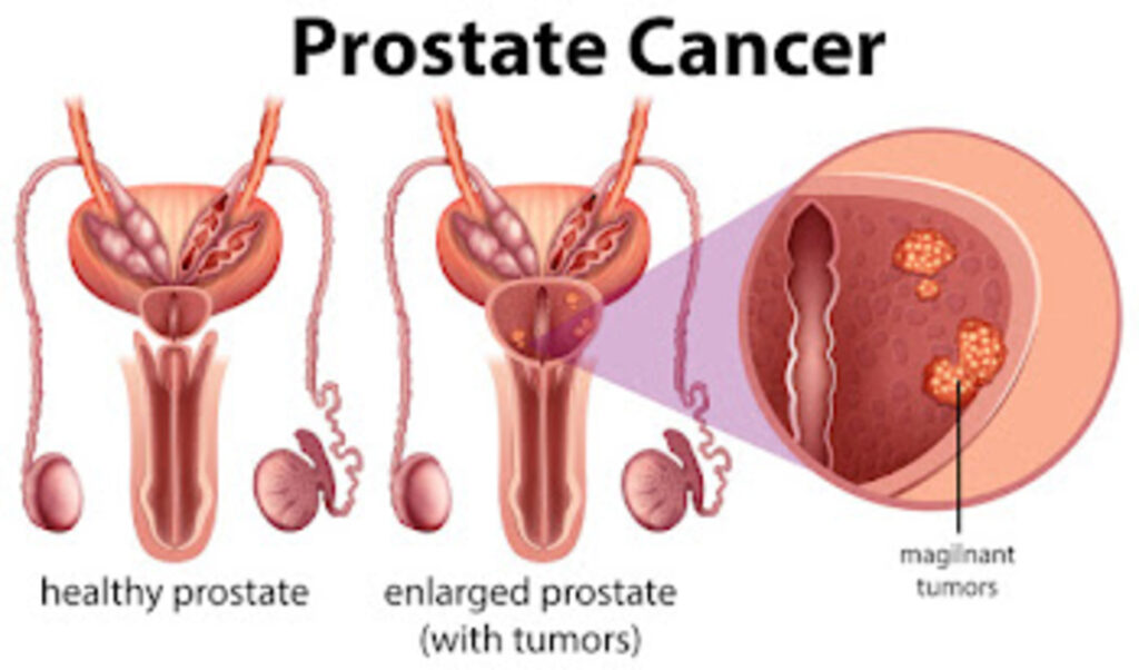 Impact of Prostate Cancer