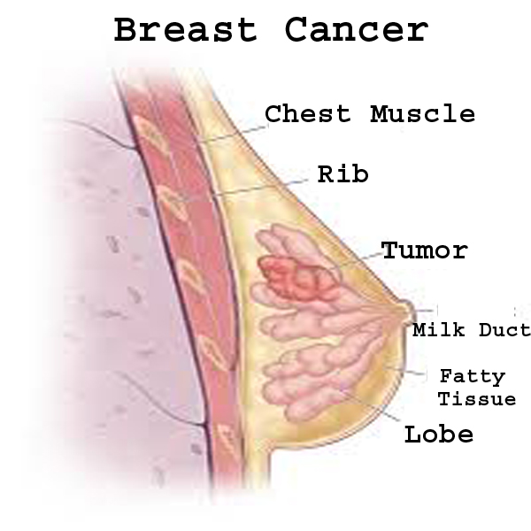 Breast Cancer Affect in the body