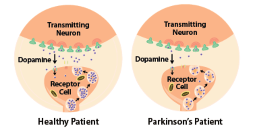 Parkinson's disease