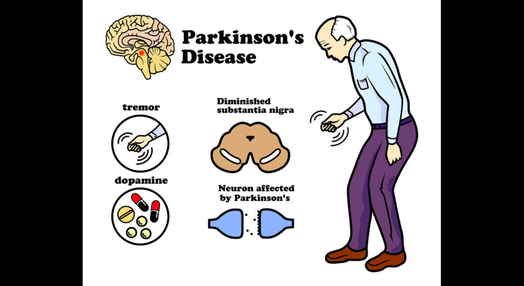 Parkinson's disease