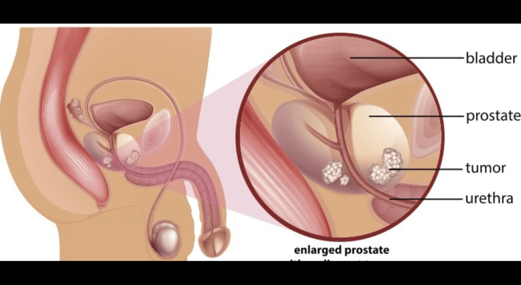 Impact of Prostate Cancer