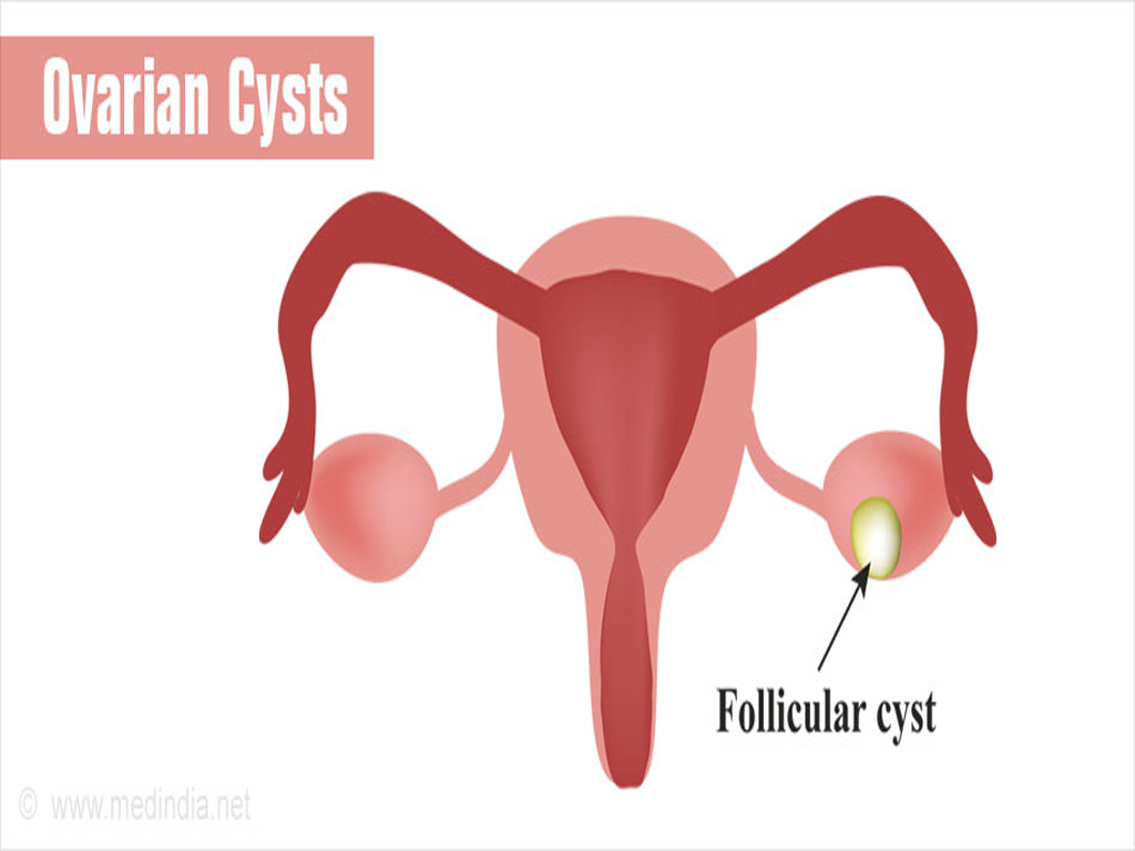 Follicular Ovarian Cyst