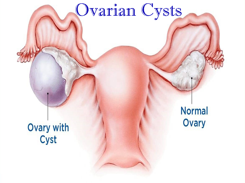 Ovarian Cysts